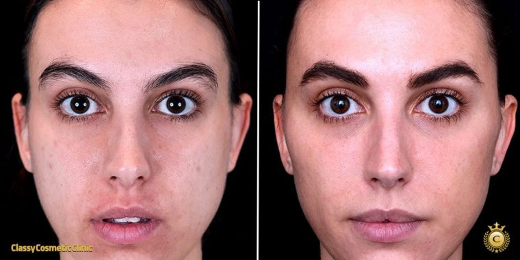 What is Full Face Rejuvenation
