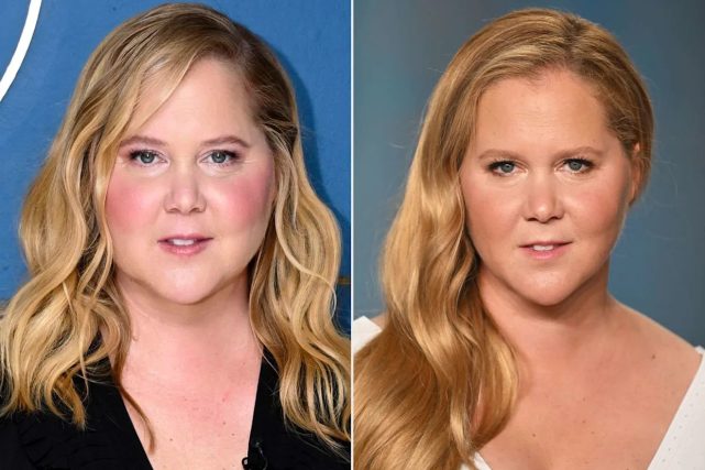 Why is Amy Schumer'S Face So Full
